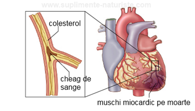 infarct-de-miocardtratament-cu-lipitoriboli-cardiovasculareateroscleroza-Копировать